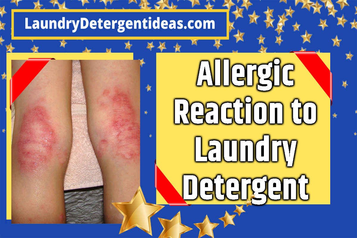 How Long Does An Allergic Reaction To Laundry Detergent Last