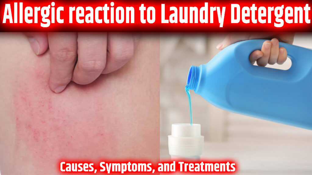 Allergic reaction to Laundry Detergent Causes, Symptoms, and Treatments