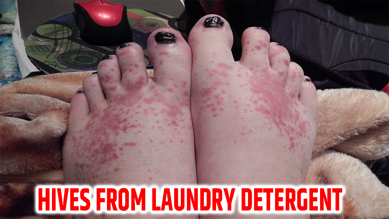 hives from laundry detergent