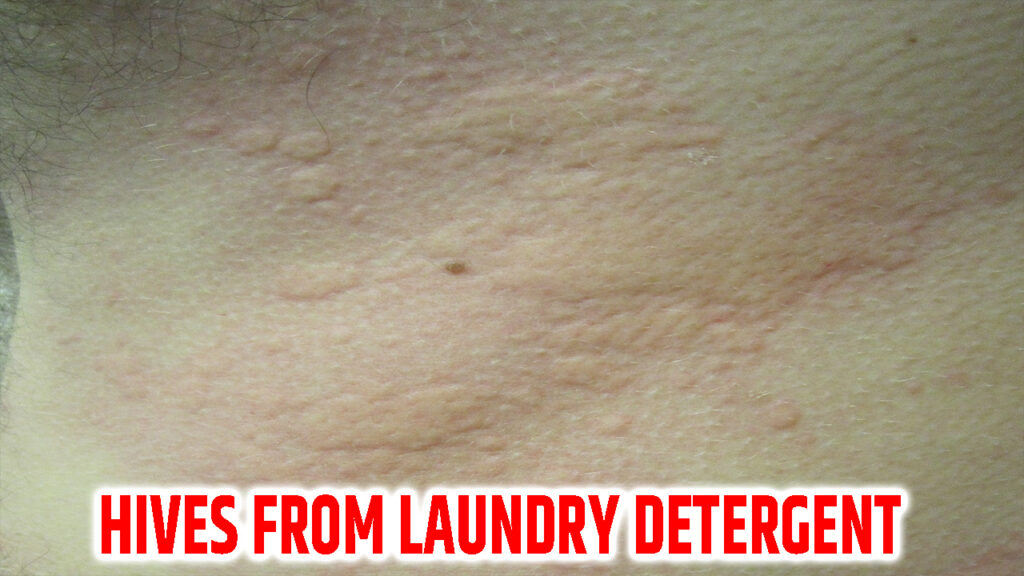 Hives From Laundry Detergent