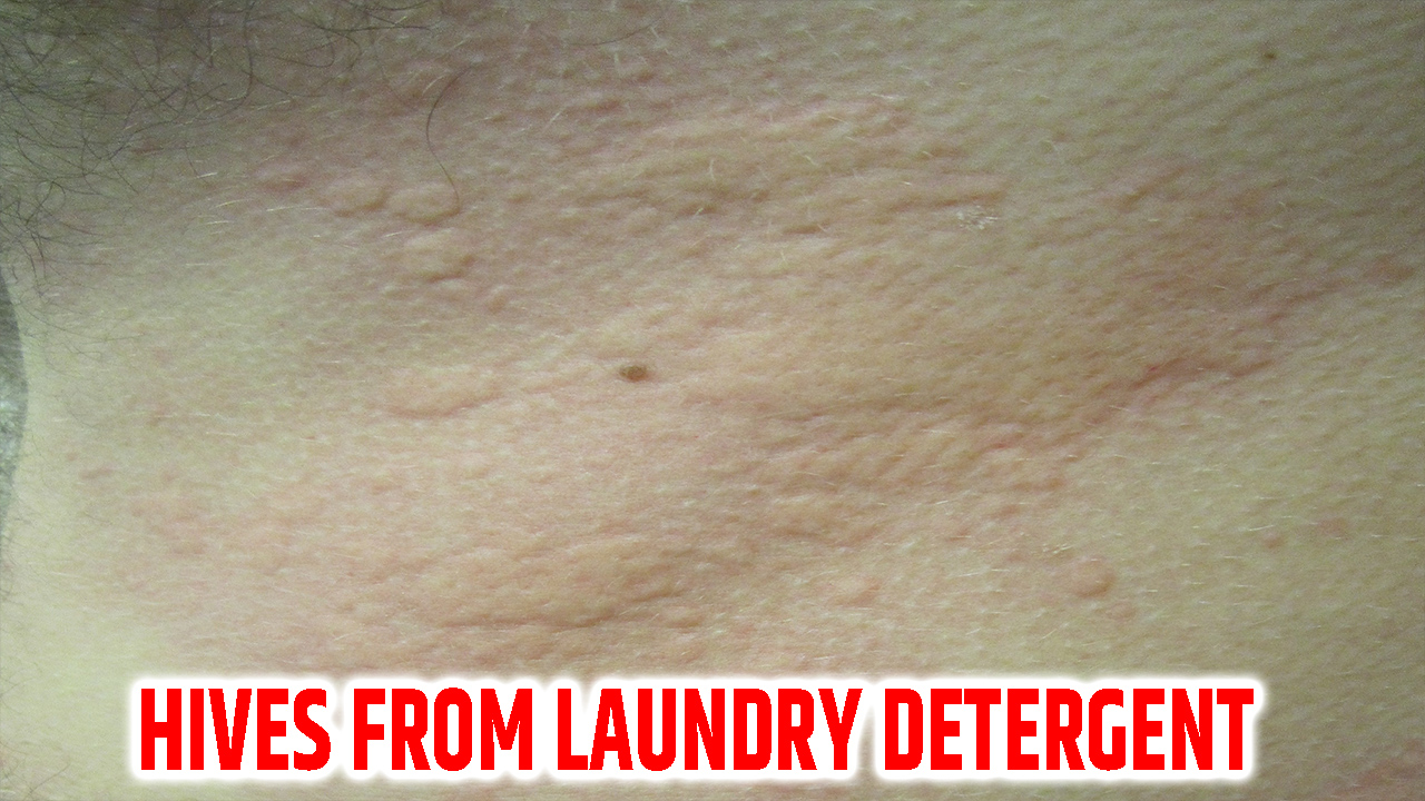 Hives From Laundry Detergent