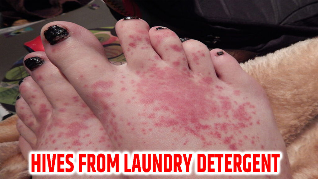 Hives From Laundry Detergent