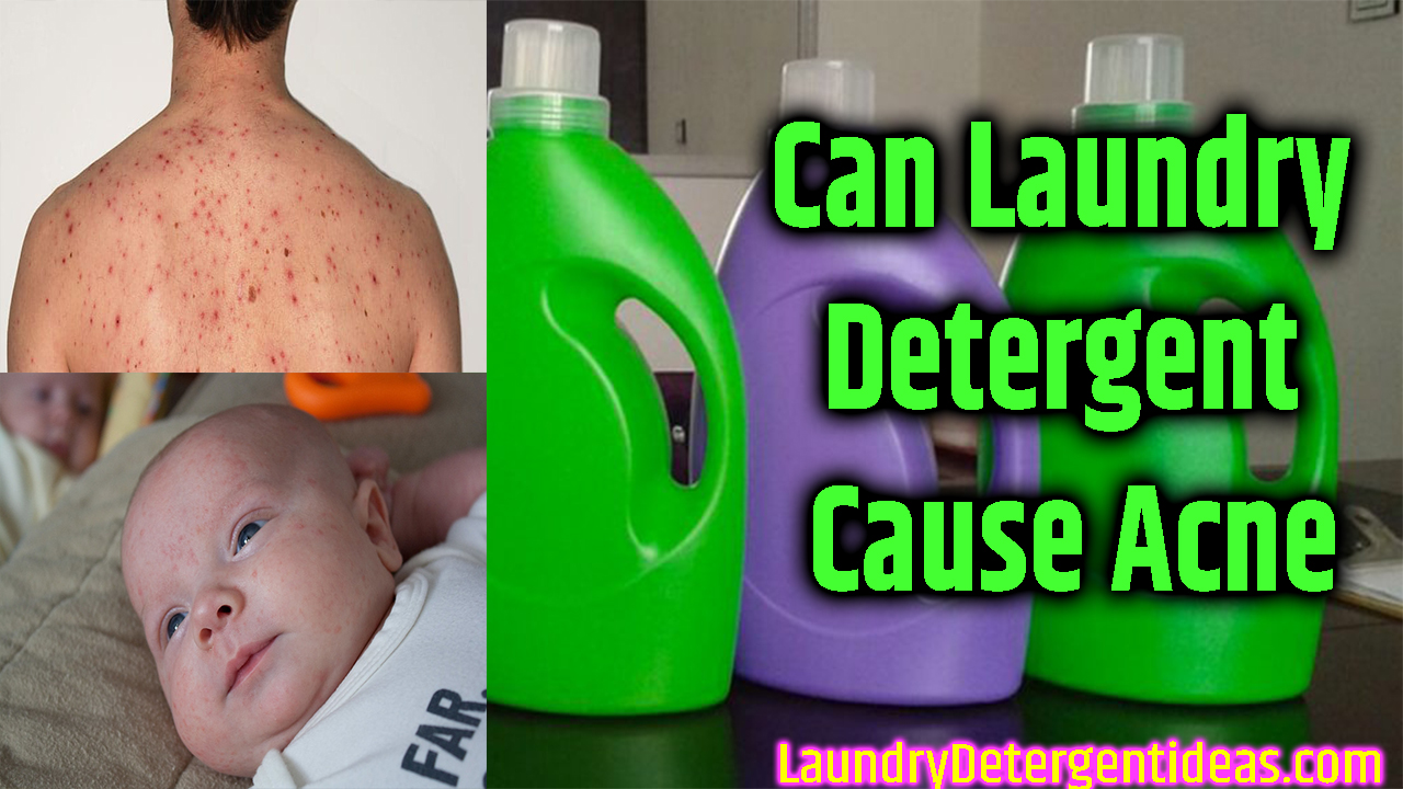 Can Laundry Detergent Cause Acne