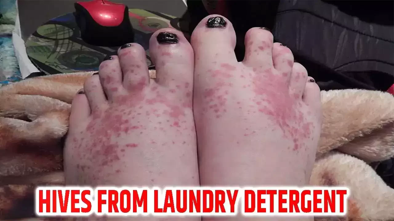 hives from laundry detergent